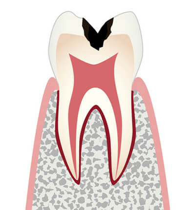 象牙質のむし歯